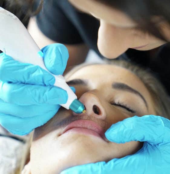 Plasma Skin Tightening